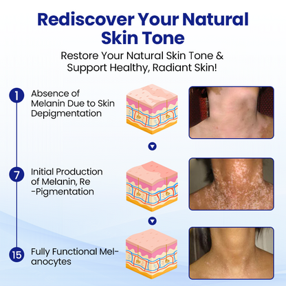 KUBOZN® Vitiligo Treatment Spray — Visible Results in Weeks, 100% Natural & Steroid-Free
