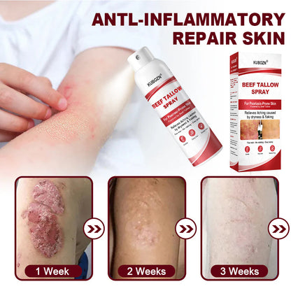 KUBOZN® Beef Tallow Spray for Itchy, Flaky Psoriasis Skin 1 (offer)