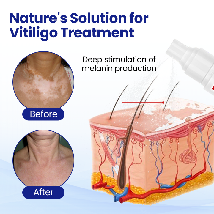 KUBOZN® Vitiligo Treatment Spray — Visible Results in Weeks, 100% Natural & Steroid-Free