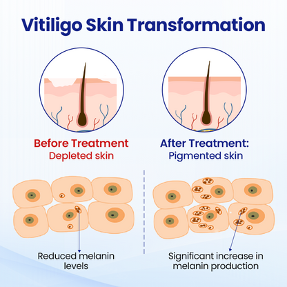 KUBOZN® Vitiligo Treatment Spray — Visible Results in Weeks, 100% Natural & Steroid-Free